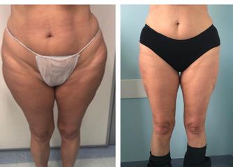 Liposuzione - Dott.ssa Francesca Mazzeo