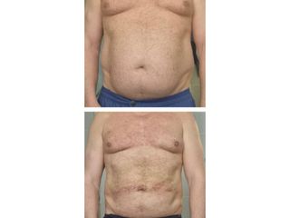 Liposuzione - Dott.ssa Francesca Mazzeo