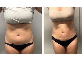 Liposuzione - Dott.ssa Francesca Mazzeo