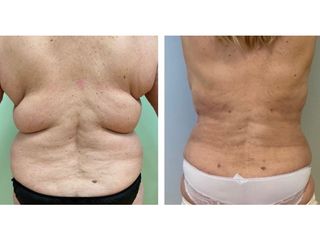 Liposuzione - Dott.ssa Francesca Mazzeo