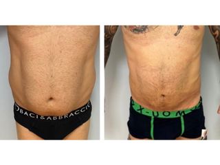 Liposuzione - Dott.ssa Francesca Mazzeo