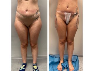 Culotte liposuzione - Dott.ssa Francesca Mazzeo