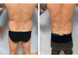 Liposuzione - Dott.ssa Francesca Mazzeo