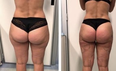 Liposuzione - Dott.ssa Francesca Mazzeo