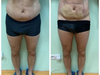 Liposcultura prima e dopo - 871174