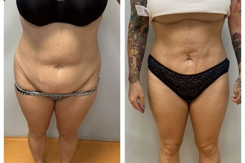 Liposuzione prima e dopo - 871175