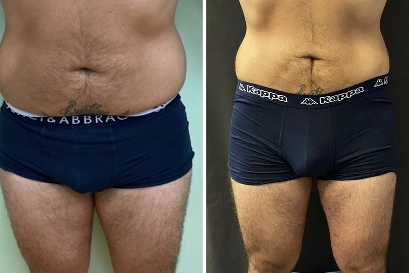 Liposuzione prima e dopo - 871179