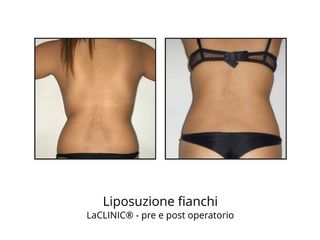 liposuzione fianchi prima e dopo