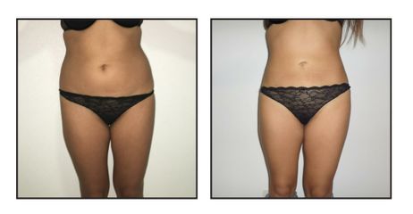 Liposuzione  - LaCLINIC® Roma