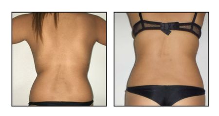 Liposuzione  - LaCLINIC® Roma