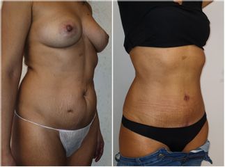 Liposuzione  - LaCLINIC® Roma