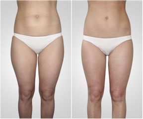 Liposuzione  - LaCLINIC® Roma