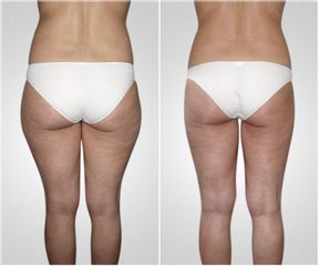 Liposuzione  - LaCLINIC® Roma