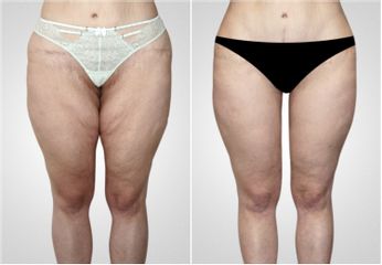 Liposuzione  - LaCLINIC® Roma
