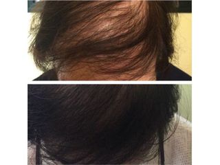 alopecia prima e dopo