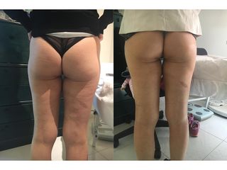 Cellulite prima e dopo