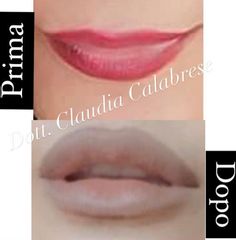 Filler labbra - Dott.ssa Claudia Calabrese