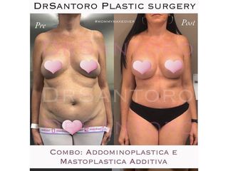 Addominoplastica - Dott. Stefano Santoro
