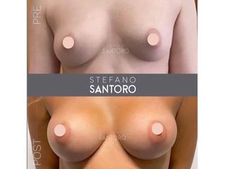 Mastoplastica additiva - Dott. Stefano Santoro