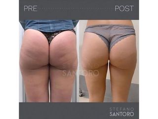 Cellulite - Dott. Stefano Santoro