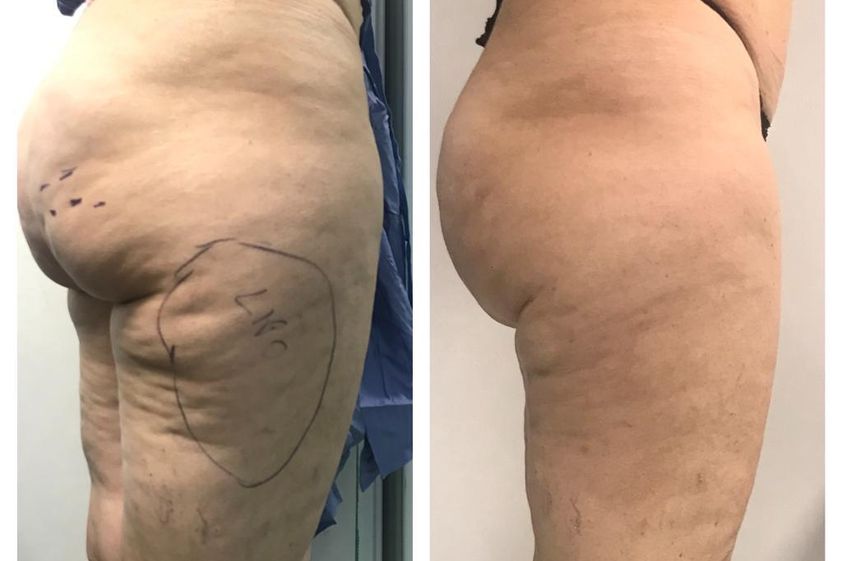 Cellulite prima e dopo - 823769