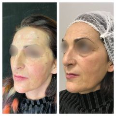 Lipofilling viso - Dr. Gioia Mario