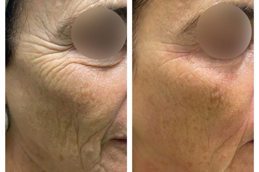 Peeling chimico prima e dopo - 824029