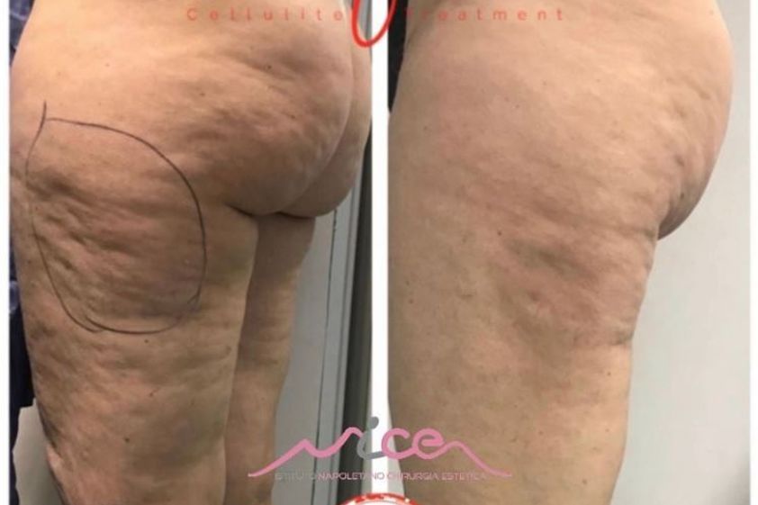 Cellulite prima e dopo - 844207