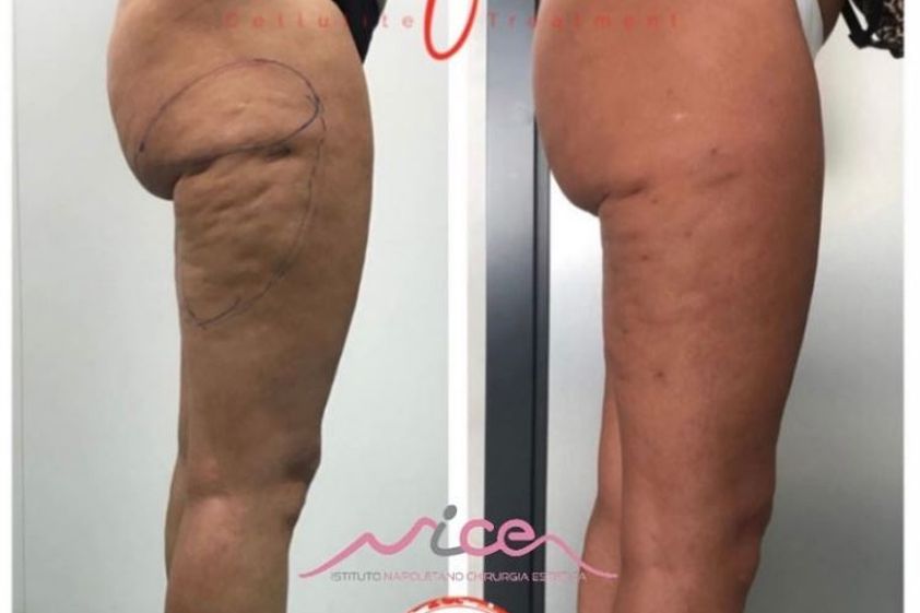 Cellulite prima e dopo - 844216