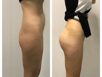 Gluteoplastica prima e dopo - 876262