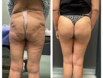 Gluteoplastica prima e dopo - 876263