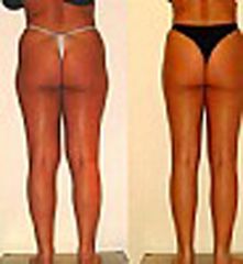 Liposcultura prima e dopo