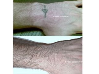 Rimozione tatuaggio