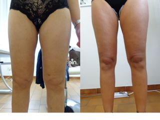 Prima e dopo Cellulite