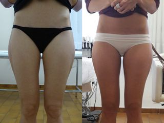 Prima e dopo Cellulite