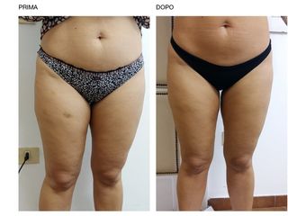 Cellulite prima e dopo