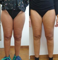 Mesoterapia cellulite - Dott.ssa Daniela Cosma