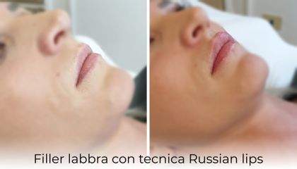 Filler labbra - Dott.ssa Daniela Cosma