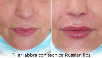 Filler labbra - Dott.ssa Daniela Cosma