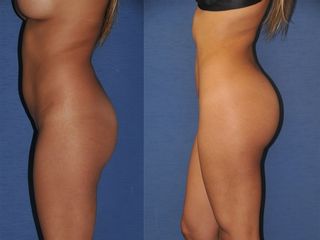 liposcultura prima dopo