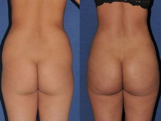 liposcultura prima dopo