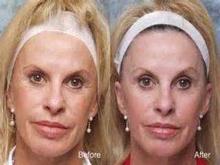 Botox prima e dopo