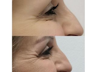 Botox perioculare prima e dopo