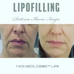 Lipofilling - NONSOLOBISTURI
