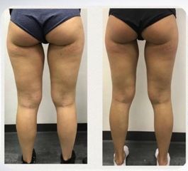 Mesoterapia Lipolitica Nonsolobisturi
