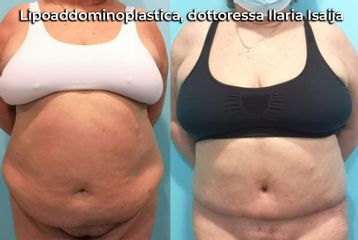lipoaddominoplastica, dottoressa Ilaria Isaija - NONSOLOBISTURI