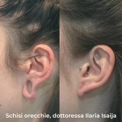 Schisi orecchi, dottoressa Ilaria Isaija - NONSOLOBISTURI