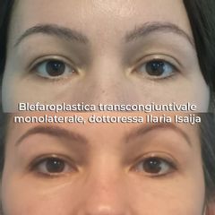 blefaroplastica transcongiuntivale monolaterale, dottoressa Ilaria Isaija - NONSOLOBISTURI