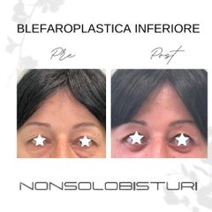 Blefaroplastica - NONSOLOBISTURI