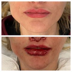 Dott Umberto Morozzo - Liplifting